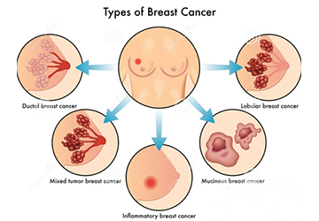 乳腺癌和乳腺增生的区别