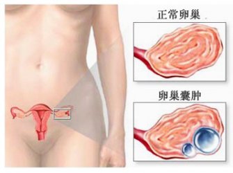 卵巢癌与卵巢囊肿的区别